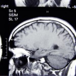 Aneurysm risk factors